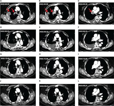 Case report: Envafolimab combined with Endostar in the treatment of advanced non-small cell lung cancer with malignant pleural effusion